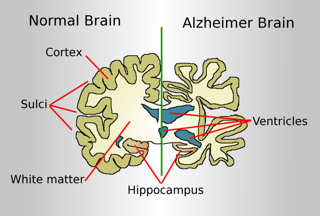 Alzheimer's family caregiving