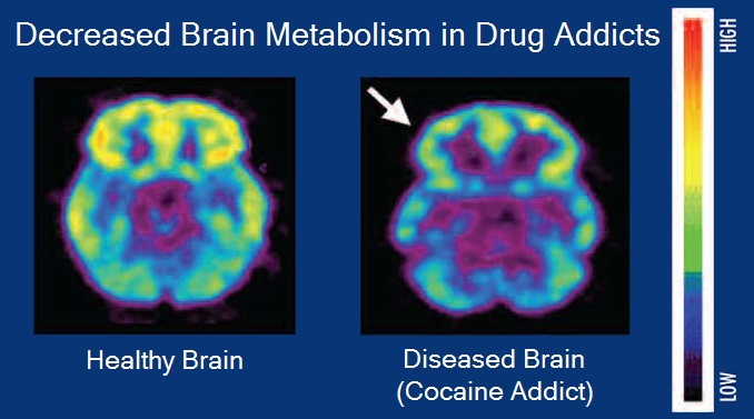 drug addiction recovery
